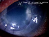 Primary graft failure with permanent corneal edema.